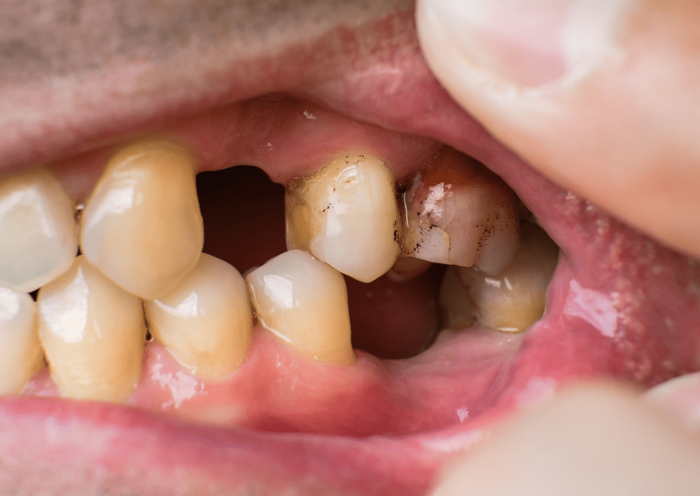 Extensive Tooth Damage or Loss