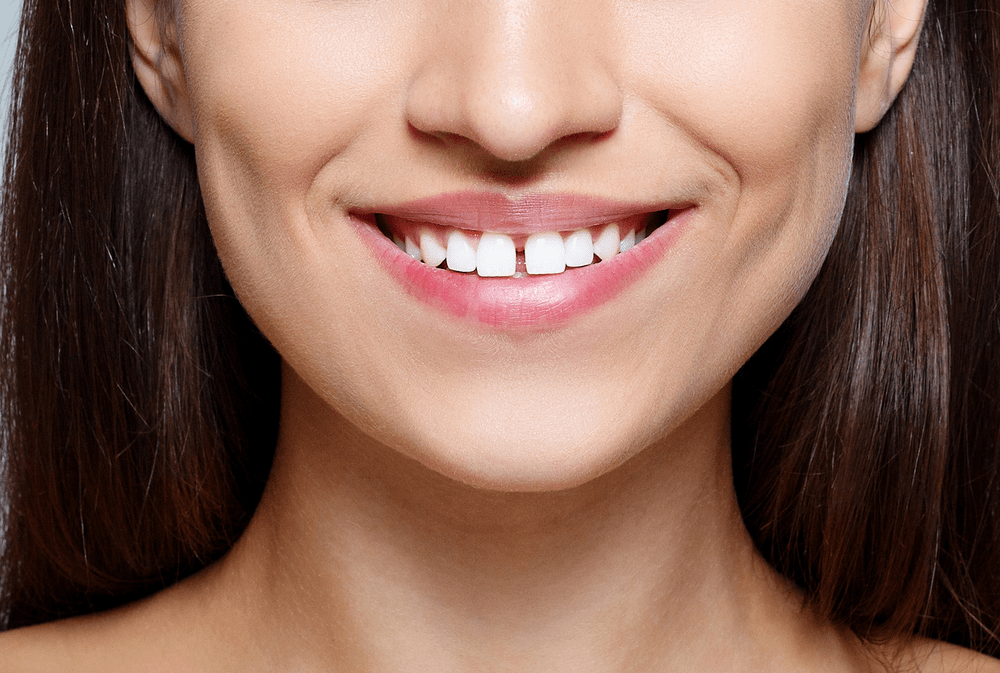 Gaps Between Teeth