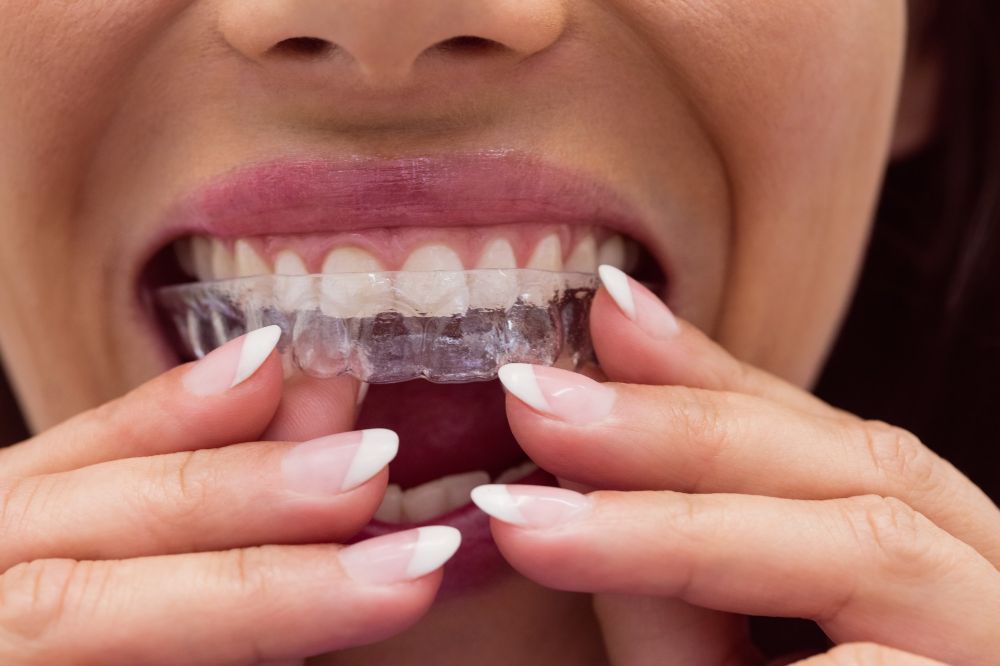 Invisalign Treatment