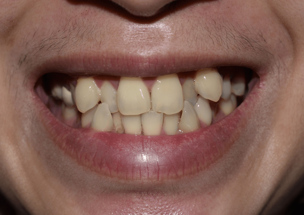Overcrowded Teeth
