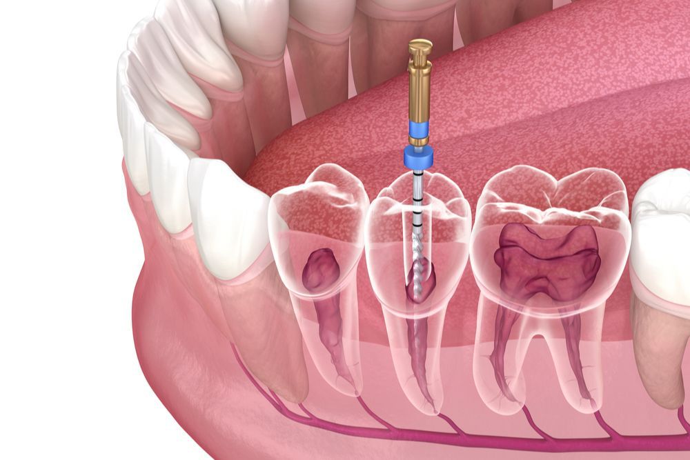 Root Canal Treatment in Adyar