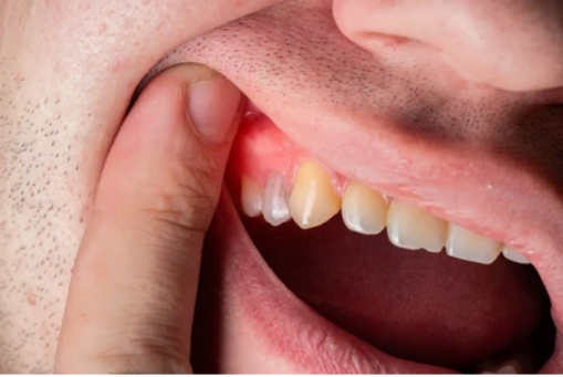 Image represent a person who is suffering from Symptoms of Dental Bone Graft Infection