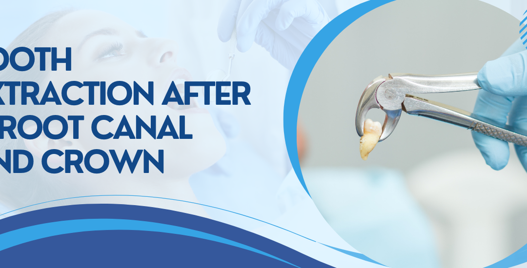Tooth Extraction After a Root Canal and Crown