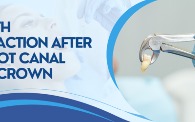 Tooth Extraction After a Root Canal and Crown