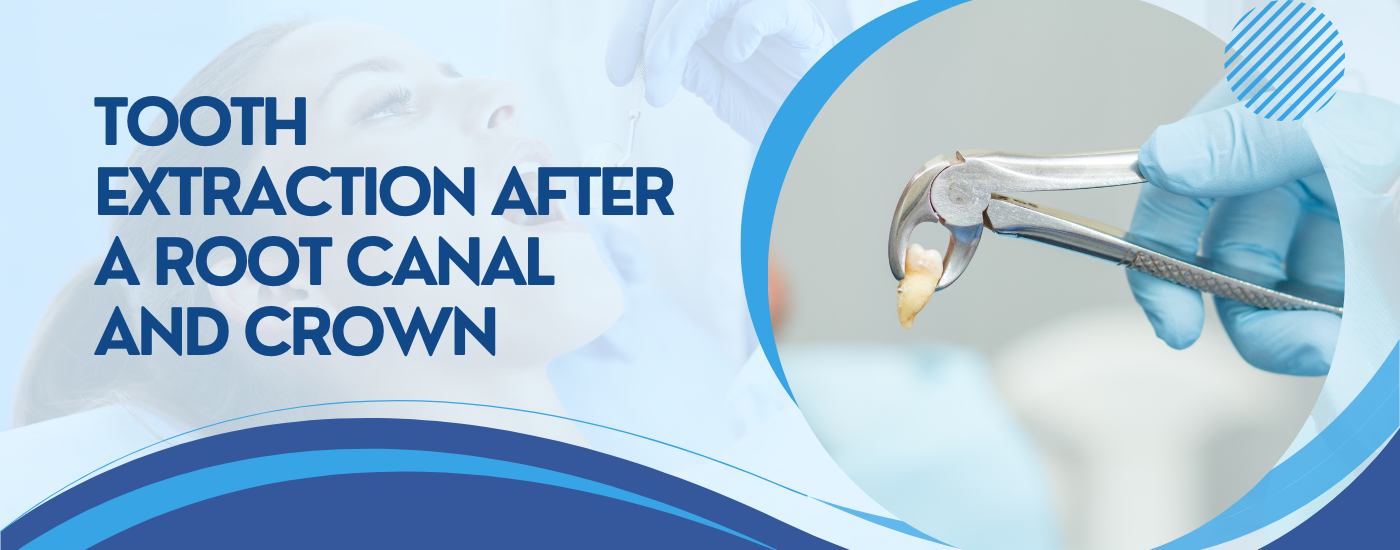 Tooth Extraction After a Root Canal and Crown