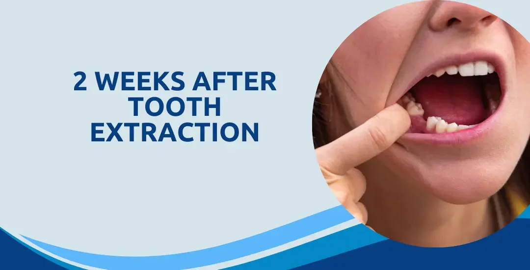 2 Weeks After Tooth Extraction
