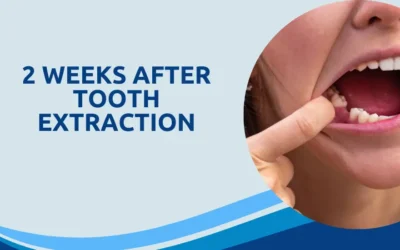 2 Weeks After Tooth Extraction