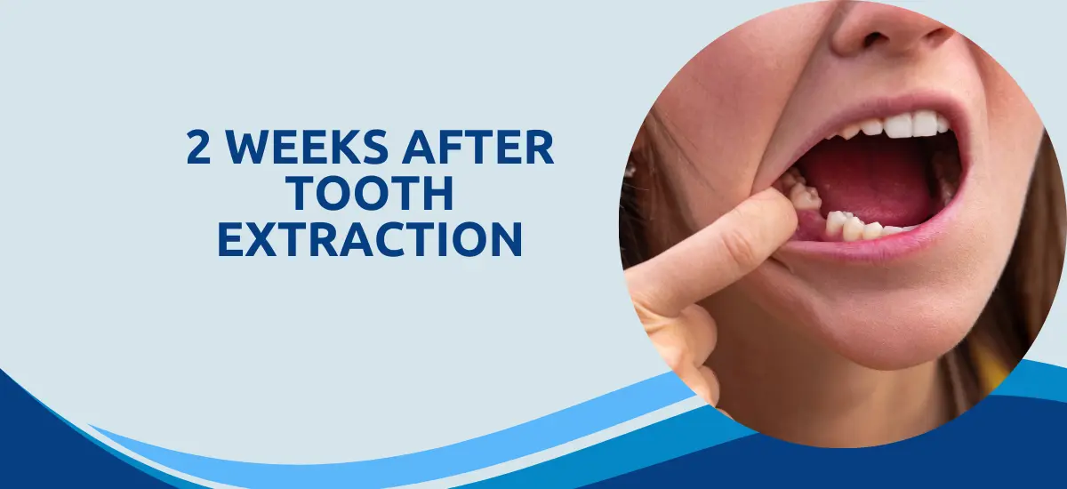 2 Weeks After Tooth Extraction