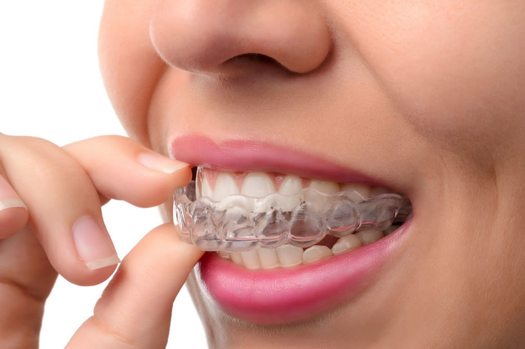 Types of Dental Crowns