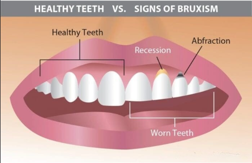 Types of Dental Crowns