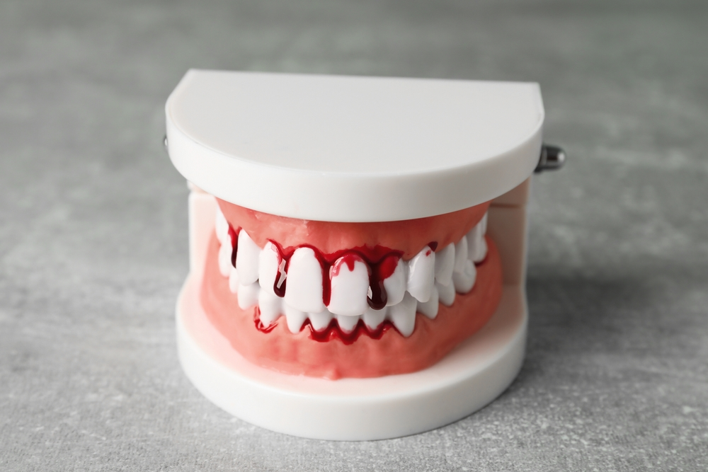 Dental model showing upper and lower teeth with red, blood-like staining on the gums, on a gray surface.