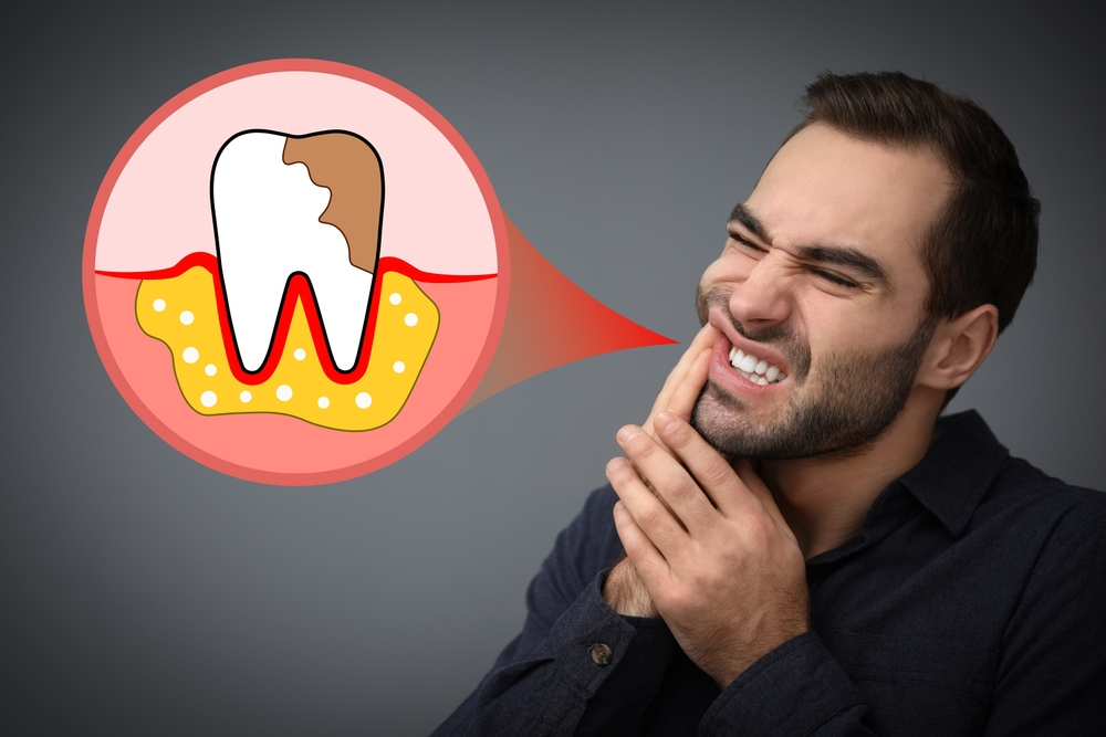 Man holding his jaw in pain beside a cartoon diagram of a decayed tooth and inflamed gums, illustrating toothache symptoms.