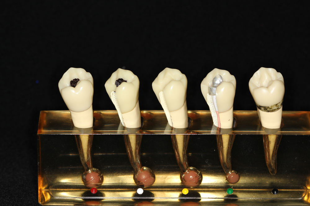 Five dental crown models mounted on implant abutments displayed on a clear stand against a black background.
