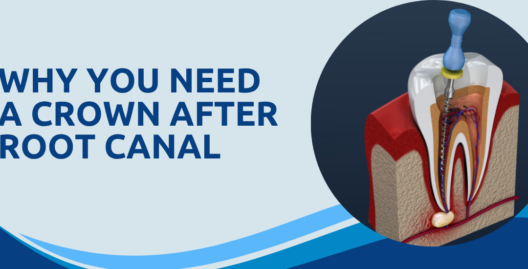 Why Do You Need a Crown After a Root Canal Treatment?