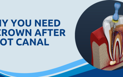 Why Do You Need a Crown After a Root Canal Treatment?