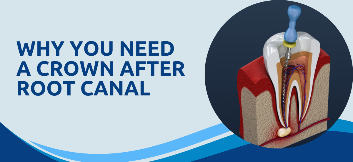 Why Do You Need a Crown After a Root Canal Treatment?