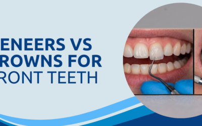 Veneers vs Crowns for Front Teeth: Which Looks Better?