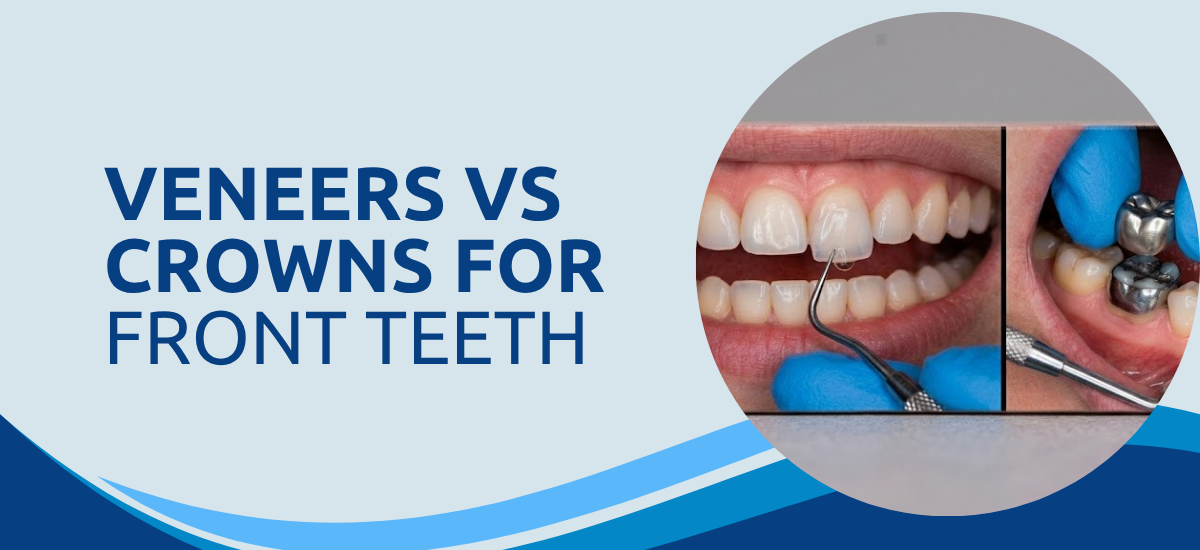 Veneers vs Crowns for Front Teeth: Which Looks Better?