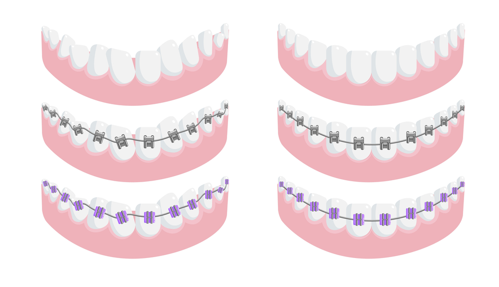 Upper and lower teeth with no braces, pink gums visible in an orthodontic illustration