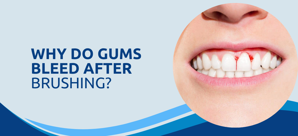 Why Do Gums Bleed After Brushing?