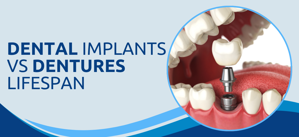 Dental Implants vs Dentures: Which Lasts Longer?