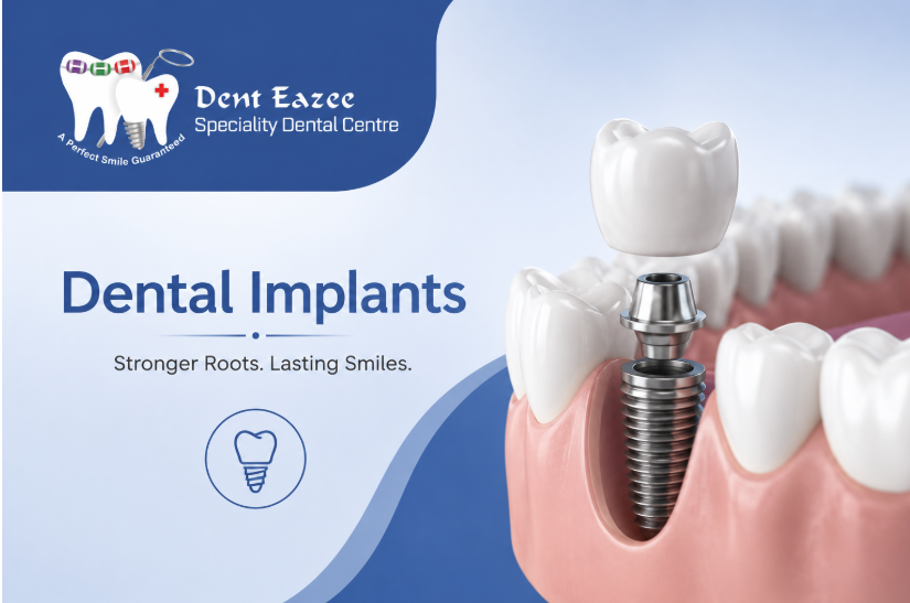 Dental Implants: The Complete Guide to Getting Your Smile Back